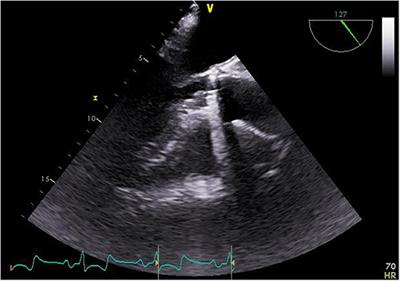 Introduction of the Rapid Deployment Aortic Valve System Use in Elderly Patients With Endocarditis